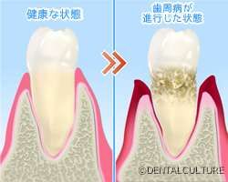 歯周病